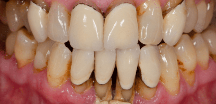 Gum Disease Treatment