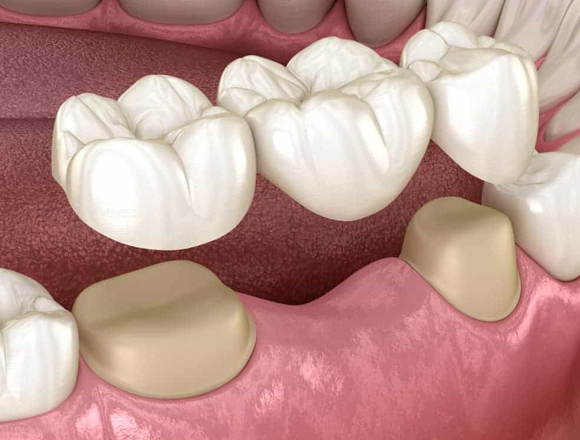dental bridges