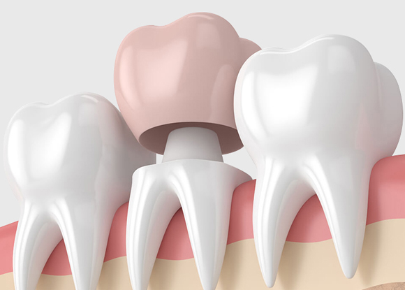 dental crowns