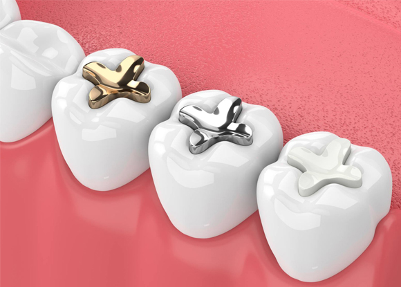 dental fillings 