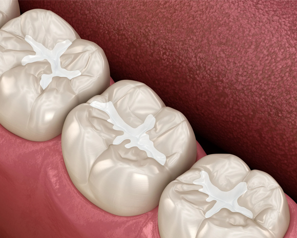Dental Sealants in Phoenix, AZ