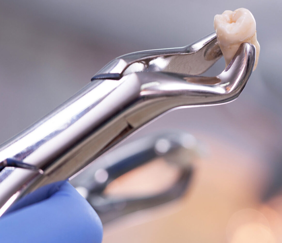 tooth extractions