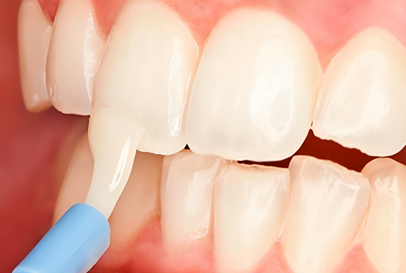 Fluoride Treatments in Phoenix, AZ