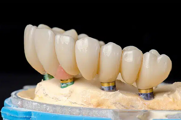 full-arch implant restorations