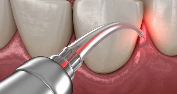 soft-tissue laser therapy