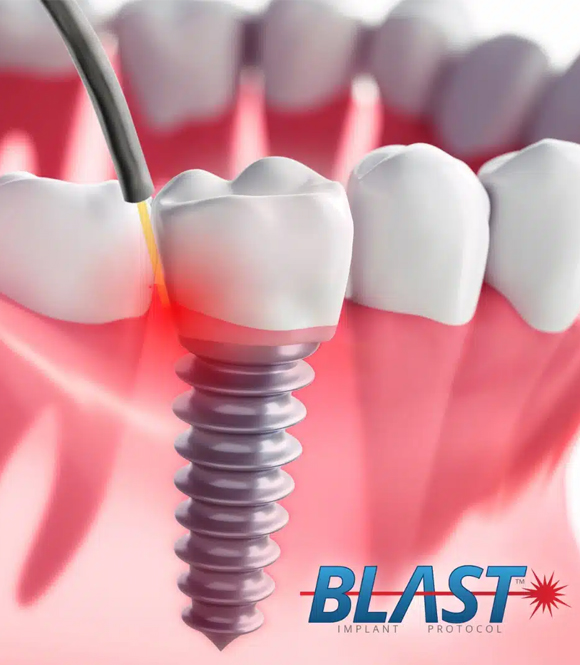 blast protocol treatment