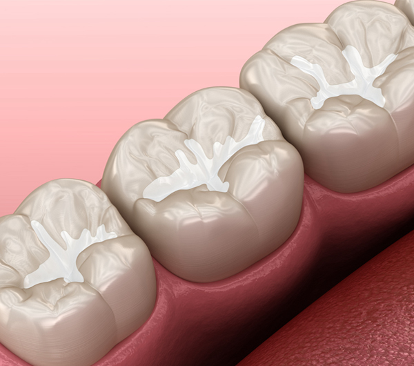 dental sealants Phoenix AZ