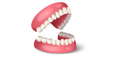 traditional dentures