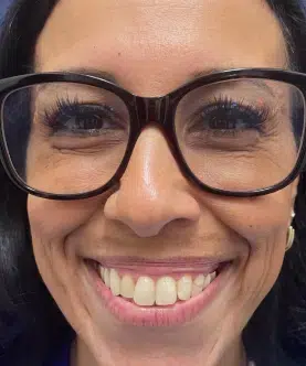 before anterior crowns