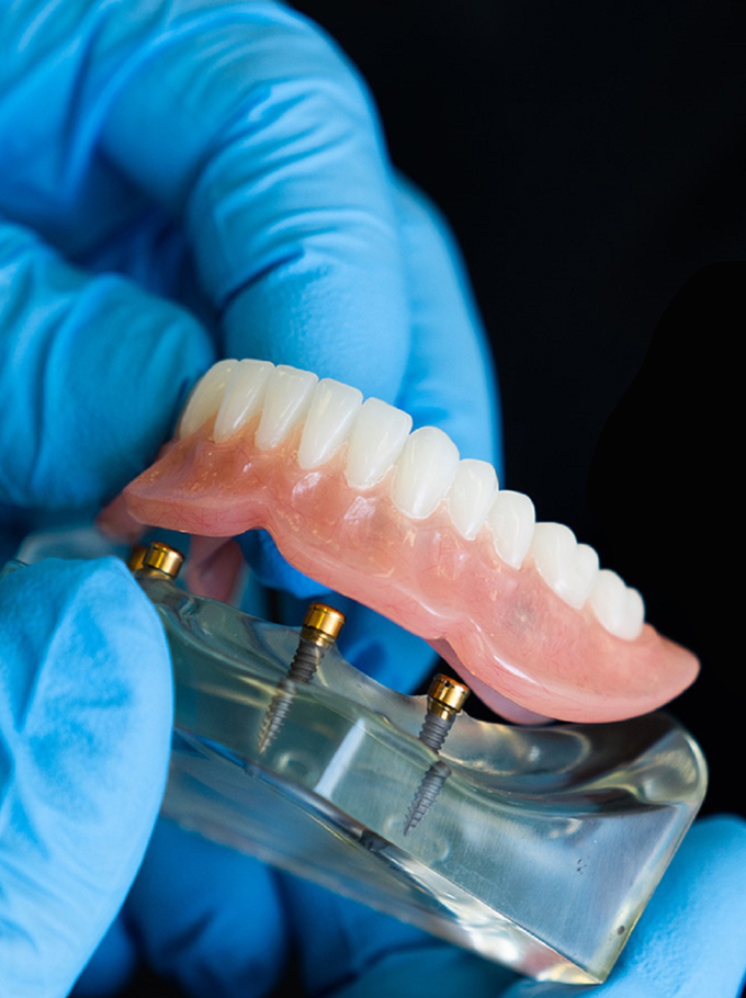 Implant-supported Dentures Phoenix AZ