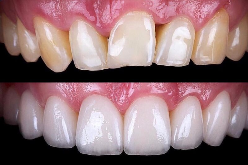 before and after veneers treatment