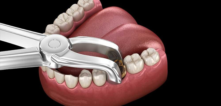 Tooth Extraction Bleeding