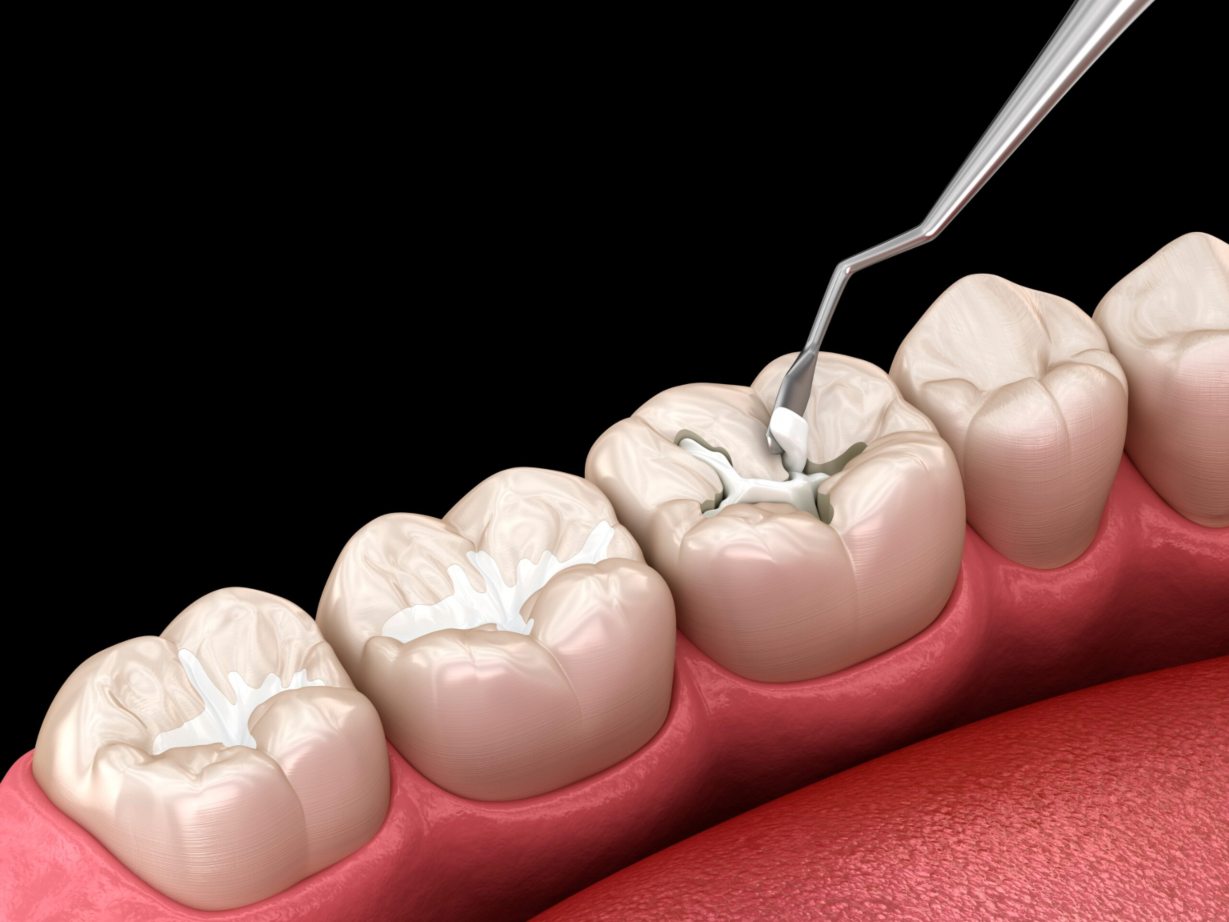 dental sealants prevent cavities