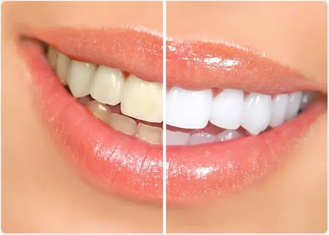 professional teeth whitening treatment 
