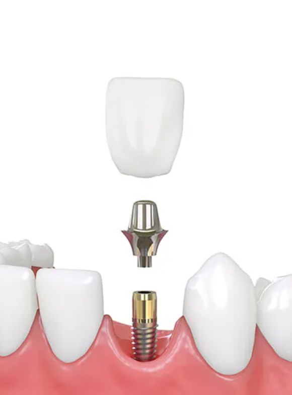dental implants Phoenix AZ