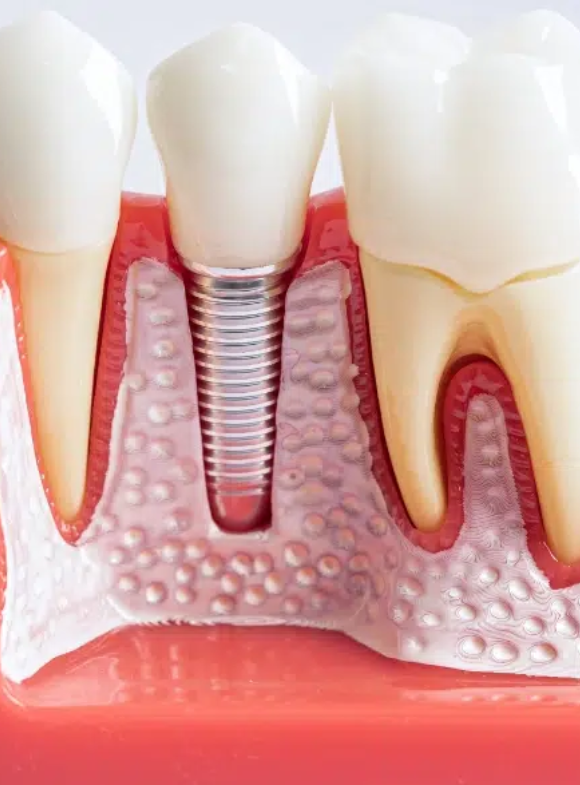 dental implants 