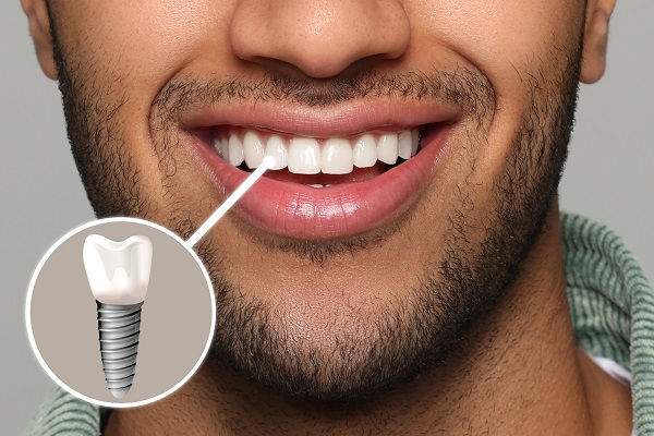 Phoenix dental implants