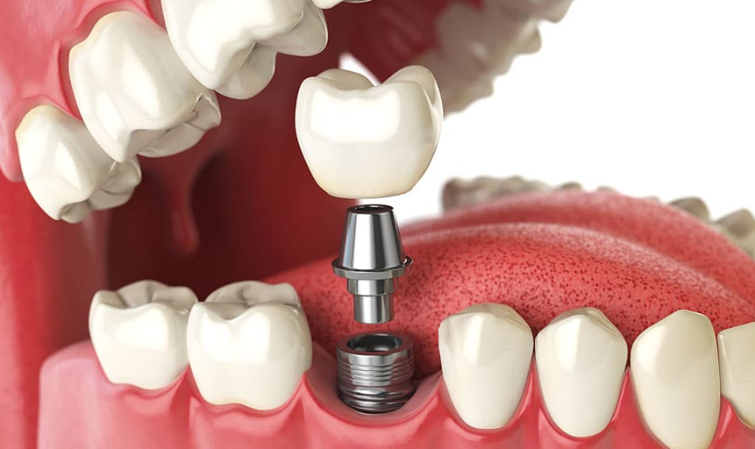 Single tooth Implants In Phoenix
