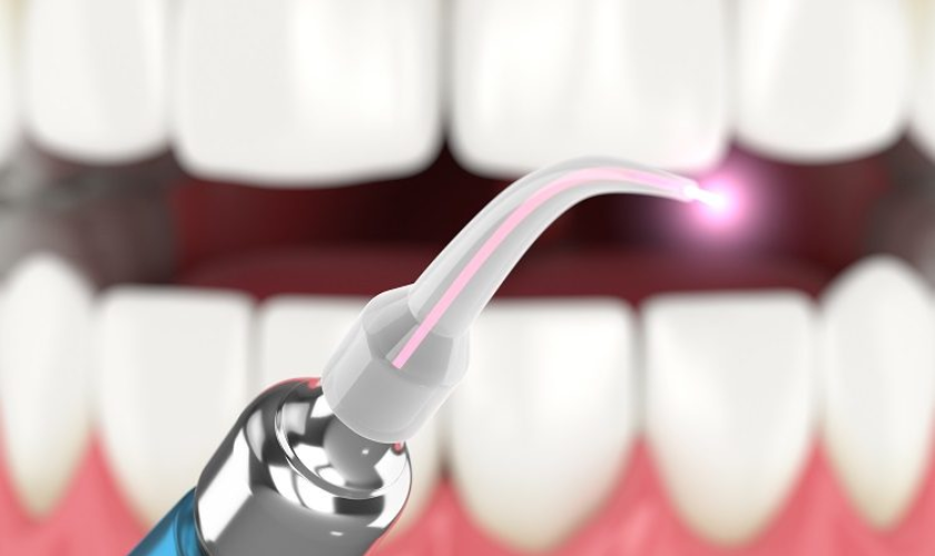 Advantages of Choosing Laser Dentistry for Your Oral Health