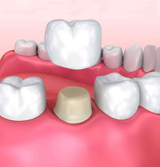 same-day crowns Phoenix AZ