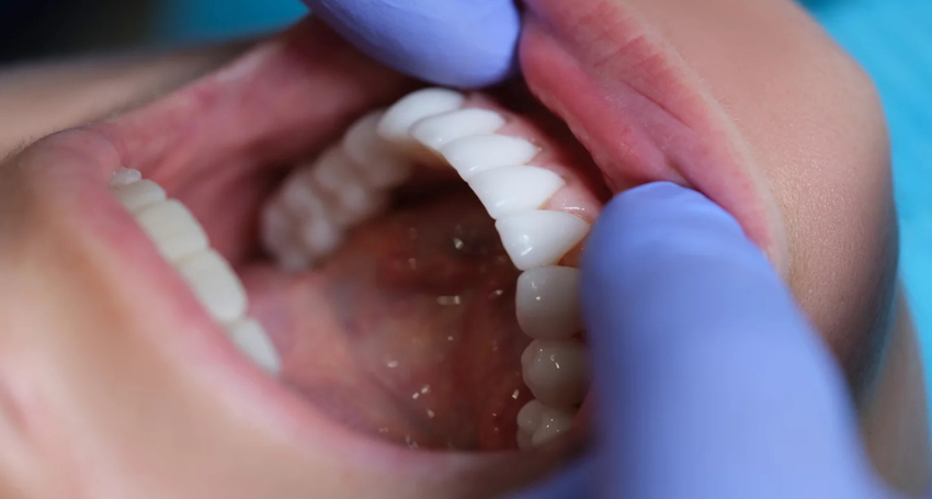 How Long Do Dental Veneers Last