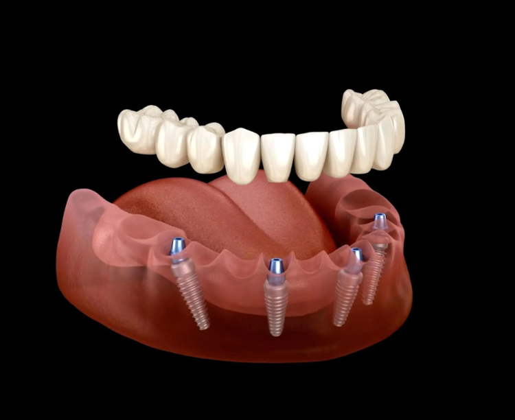 dental implants in phoenix dentist