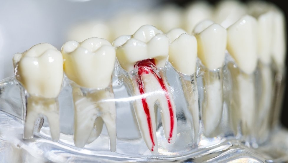can root canal therapy save severely damaged teeth